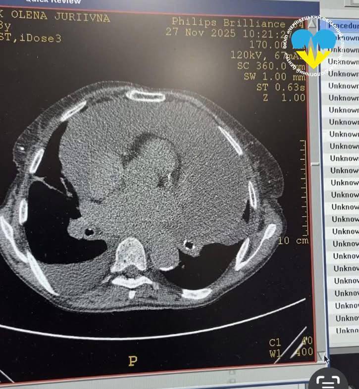 Мешканці Путильщини із серця відкачали майже 2,5 літра рідини